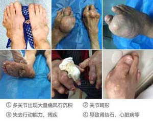 痛风晚期症状.jpg