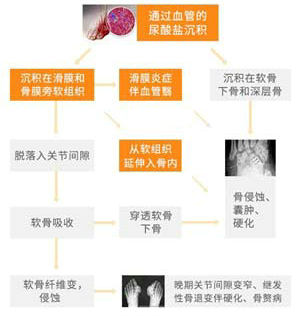 痛风连续发生的病理改变_副本.jpg